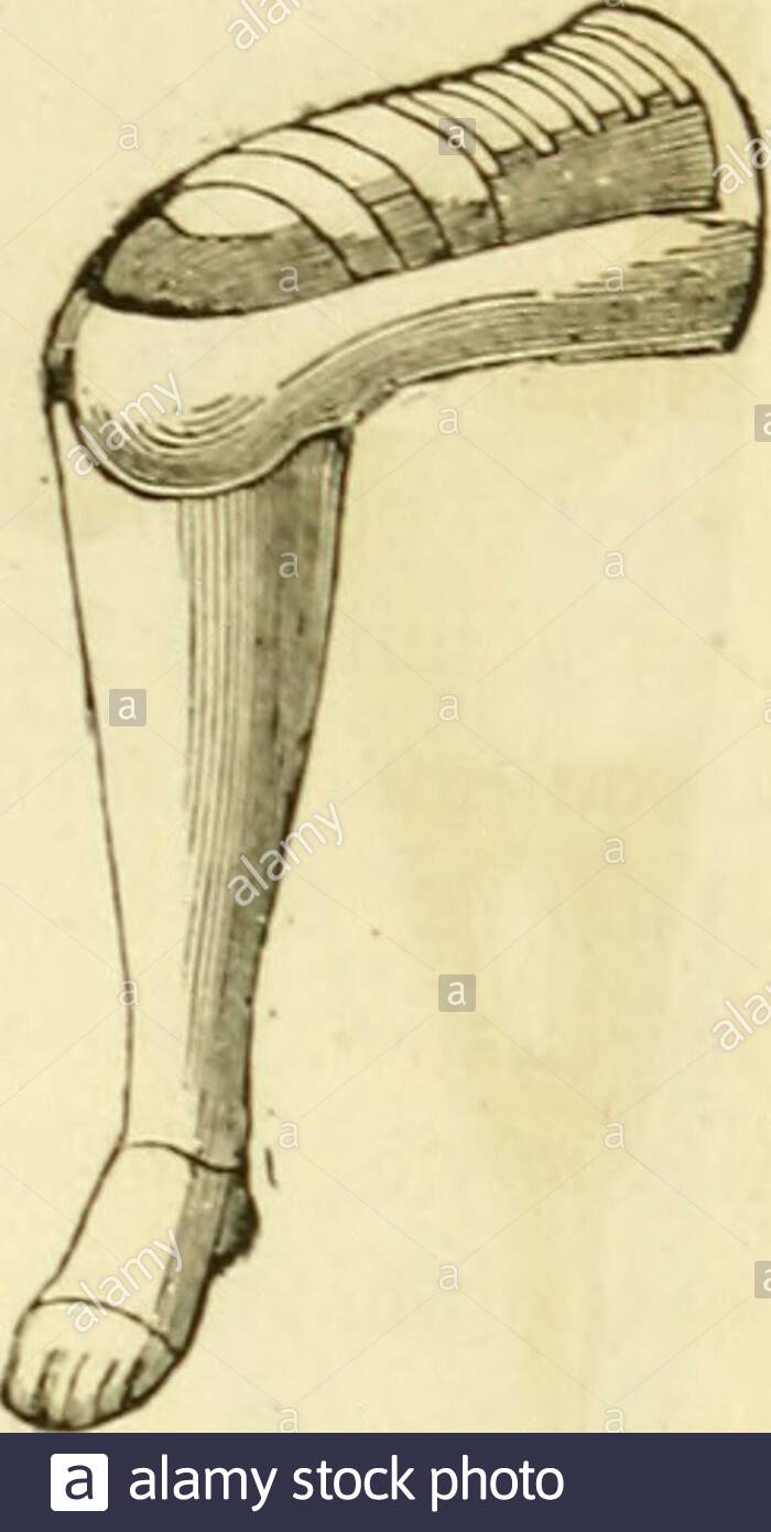 arsenal de la chirurgie contemporaine description mode demploi et apprciation des appareils et instruments en usage pour le diagnostic et le traitement des mala s chirurgicales lorthop la prothse les oprations simples gnrales spciales et obsttricales du sommetde la tubrosit antrieure du tibia contourne le t interne de la jambe pour se rendre en arriresur le milieu du pli du genou une incision identi que est faite sur le ct externe on a ainsi deux fie rgt9i appareil de lliiilson dsarticulation petits lambeaux que i on dissque en deu 2AJ8354